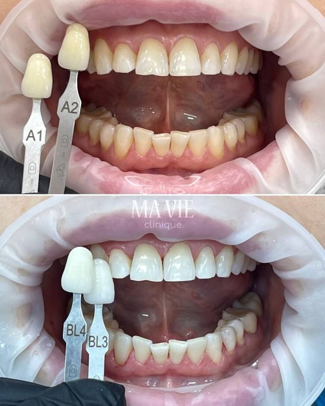 Как зубной налет может повлиять на здоровье: что нужно знать