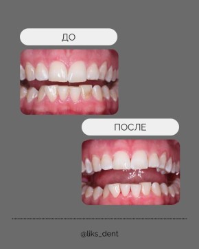 Чистка зубов: ключ к сияющей улыбке и здоровью ваших зубов