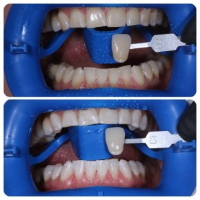 7 простых шагов, чтобы забыть о кариесе и стоматологах