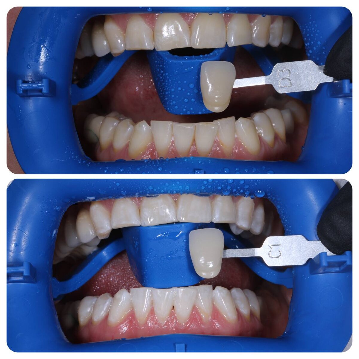 7 простых шагов, чтобы забыть о кариесе и стоматологах