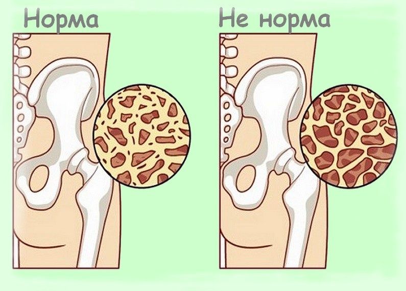 Как сохранить крепкие кости после 55: советы, которые действительно работают